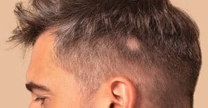 A qué edad se estabiliza la alopecia androgénica