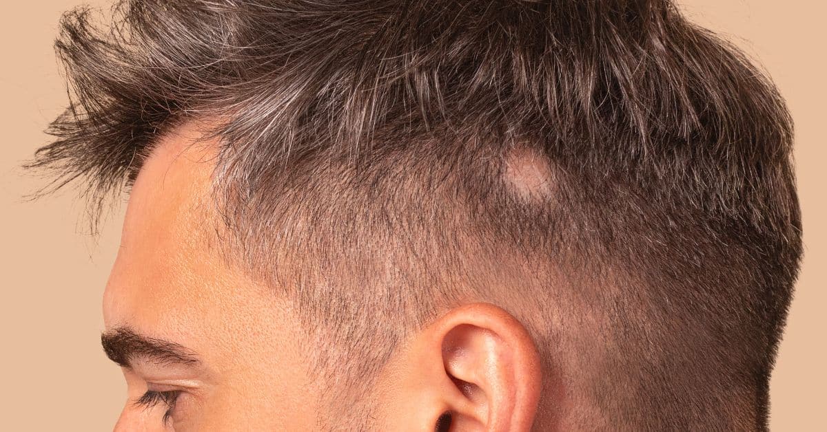 A qué edad se estabiliza la alopecia androgénica