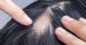 Alopecia areata en mujeres