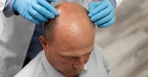 Médico revisando el cuero cabelludo de un hombre con alopecia avanzada, ilustrando la búsqueda de una solución profesional para la alopecia avanzada.