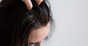 Cuero cabelludo con signos visibles de caspa, un problema común que requiere cuidados específicos para mejorar.