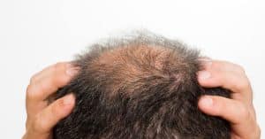 ¿De quién se hereda realmente la calvicie? ¿Es genética?