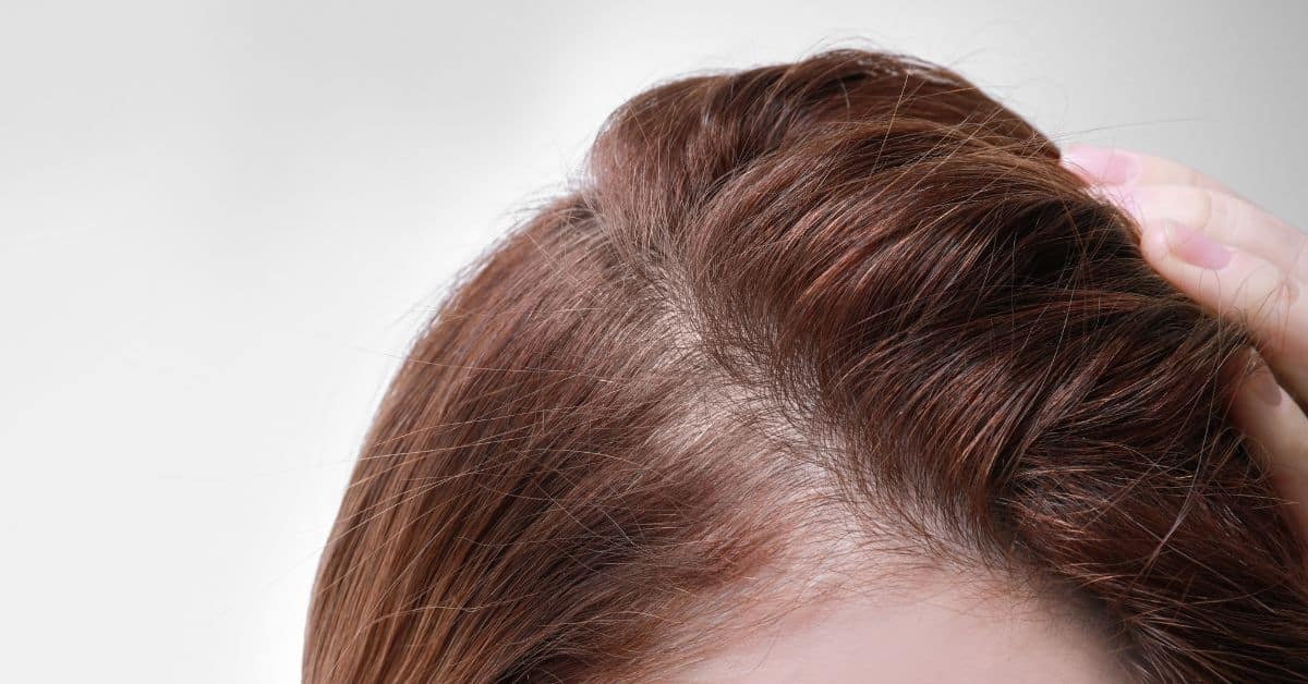 Entradas en el pelo en mujeres