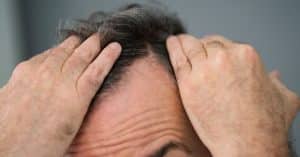 La alopecia tiene cura