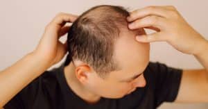 Obesidad y caída del cabello