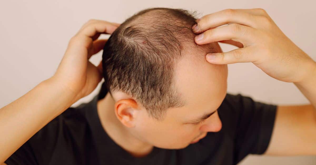 Obesidad y caída del cabello