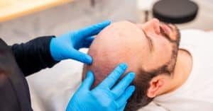 Evaluación previa al injerto capilar dentro del preoperatorio recomendado para optimizar la cirugía.