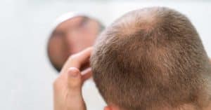 sintomas de la alopecia caida del cabello