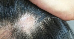 Ejemplo de pérdida de cabello causada por tiña en el cuero cabelludo.